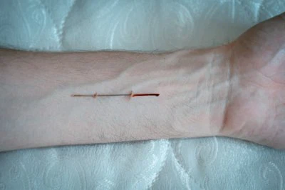 Laparoscopy Shaver Blades: Σενάρια Κλινικής Εφαρμογής